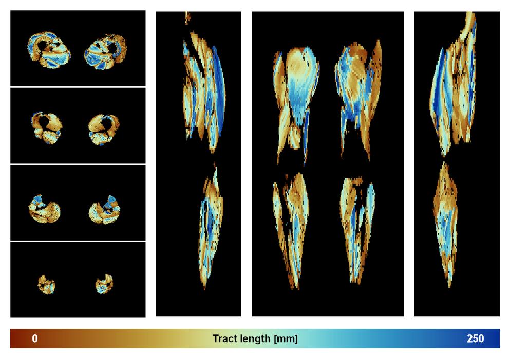 Muscle fiber tract length map based on whole leg DTI based fiber tractography.
