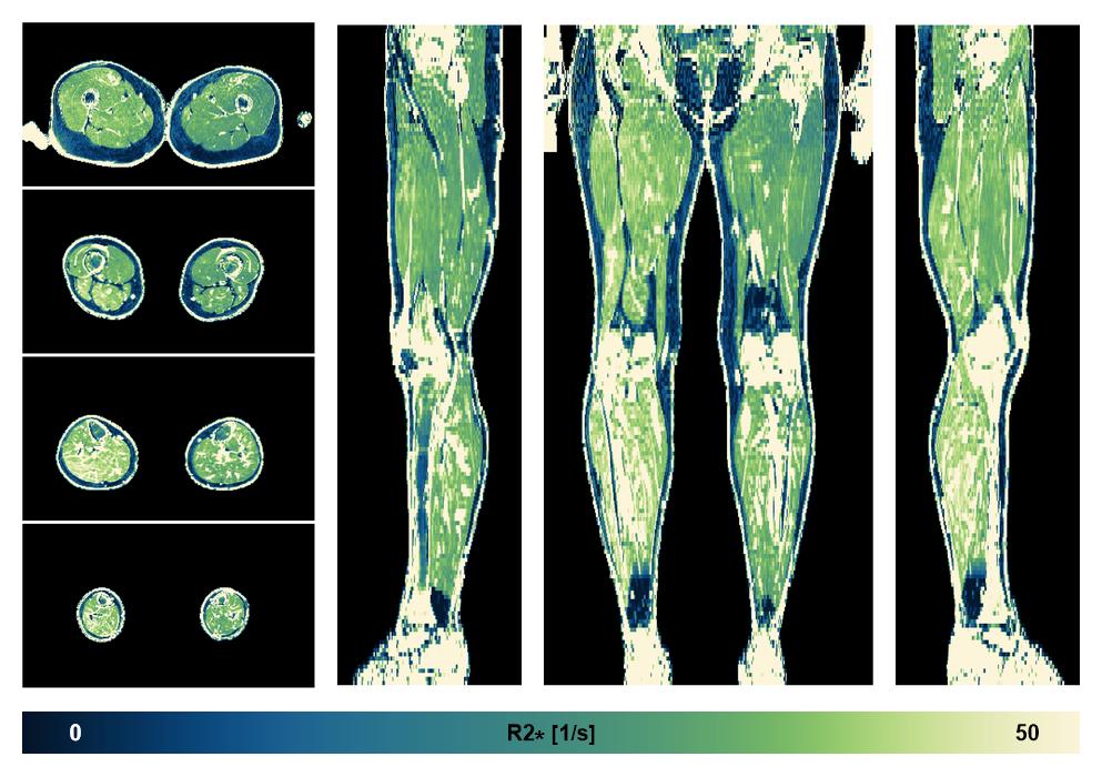 The R2 star relaxation time of the lower extremity obtained from the dixon reconstruction for muscle water fat quantification.