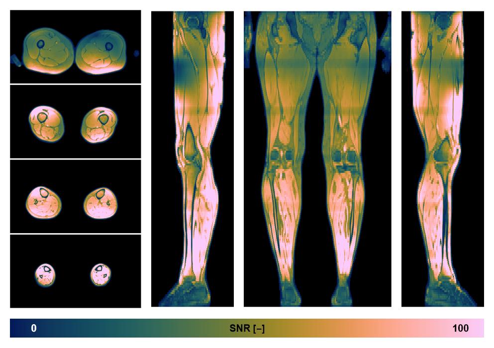 The SNR distribution of the dixon data.