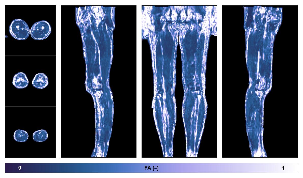 IVIM corrected whole leg muscle fractional anisotropy obtained from diffusion tensor imaging.