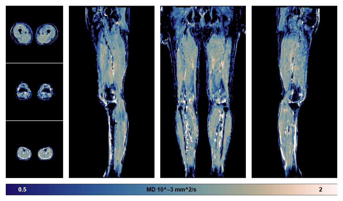 IVIM corrected whole leg muscle mean diffusivity obtained from diffusion tensor imaging.