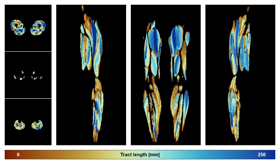 Muscle fiber tract length map based on whole leg DTI based fiber tractography.