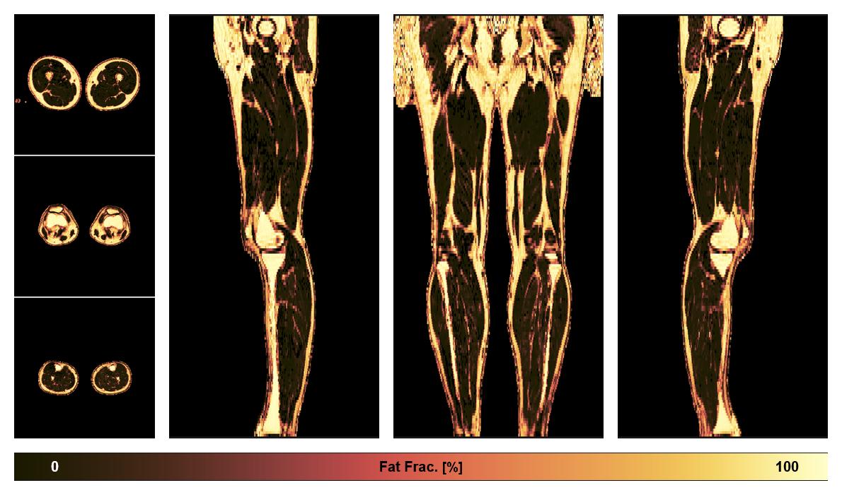 The fat fraction of the lower extremity obtained from the dixon reconstruction for muscle water fat quantification.