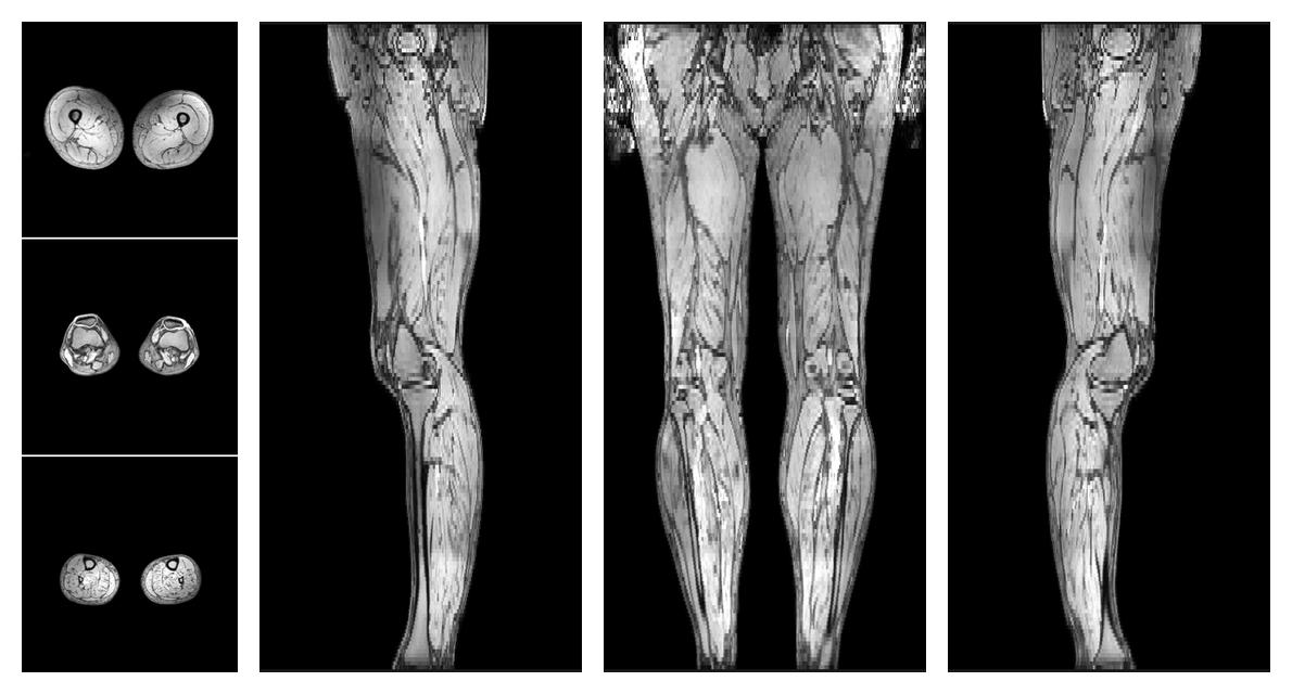 The out-phase image of the dixon reconstruction for water fat quantification.