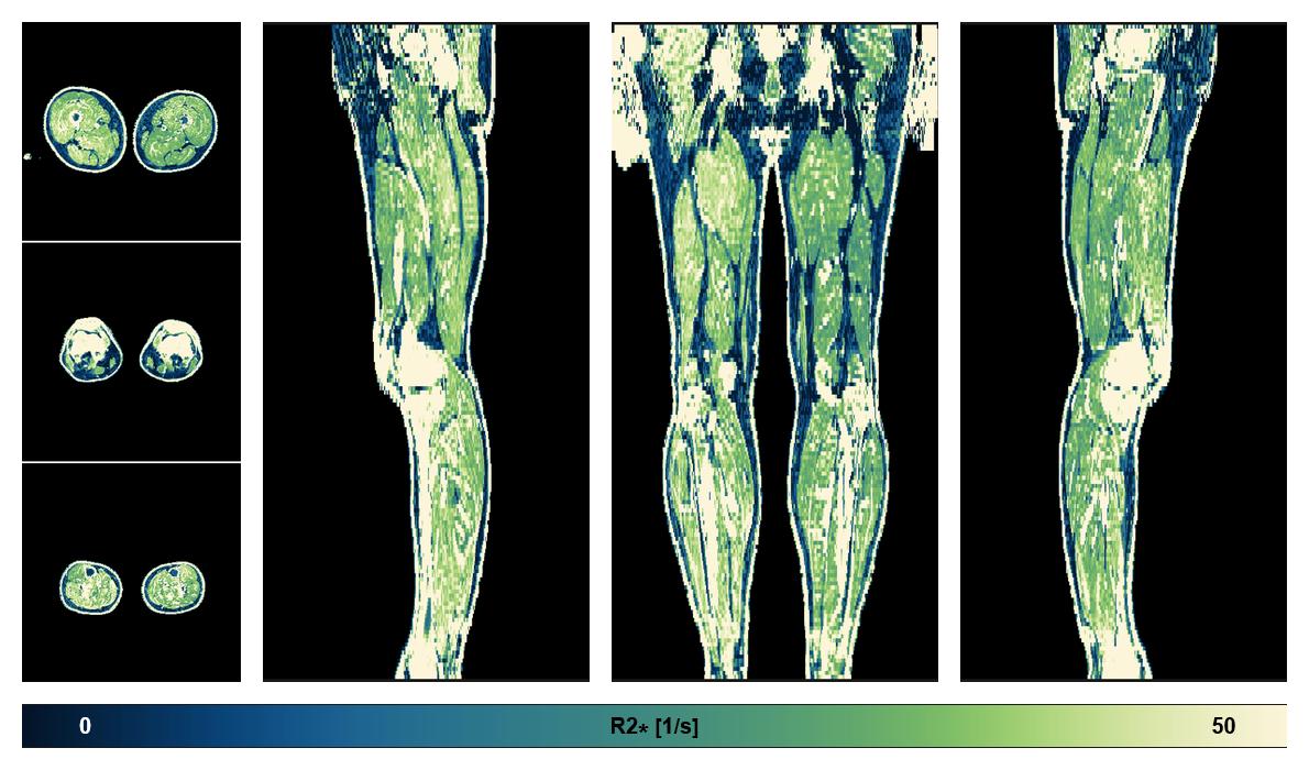The R2 star relaxation time of the lower extremity obtained from the dixon reconstruction for muscle water fat quantification.