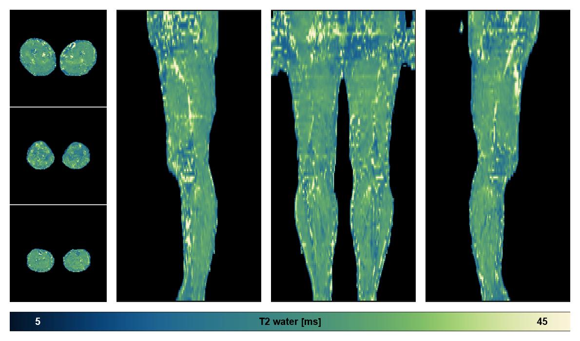 The water only T2 relaxation time of the lower extremity obtained from multi echo spin echo t2 mapping with EPG based reconstruction.
