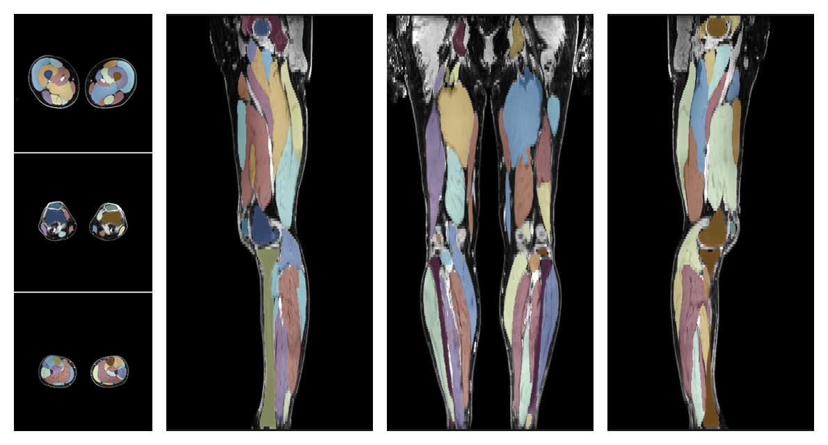 Overlay of automated muscle segmentation labels on dixon water image.