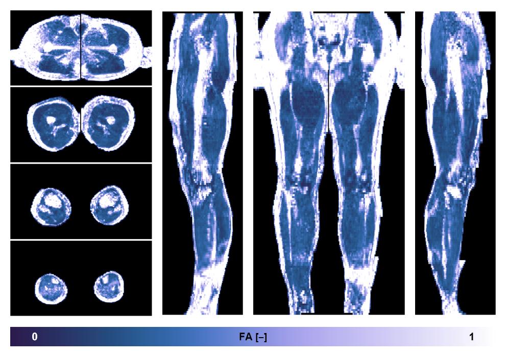 IVIM corrected whole leg muscle fractional anisotropy obtained from diffusion tensor imaging.