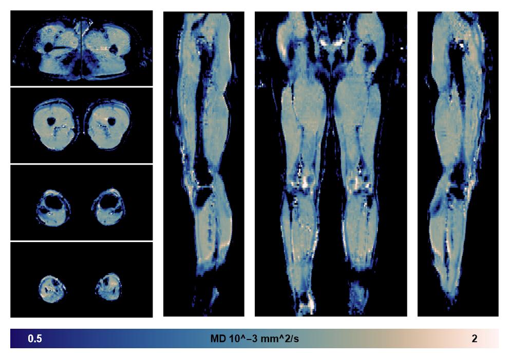 IVIM corrected whole leg muscle mean diffusivity obtained from diffusion tensor imaging.