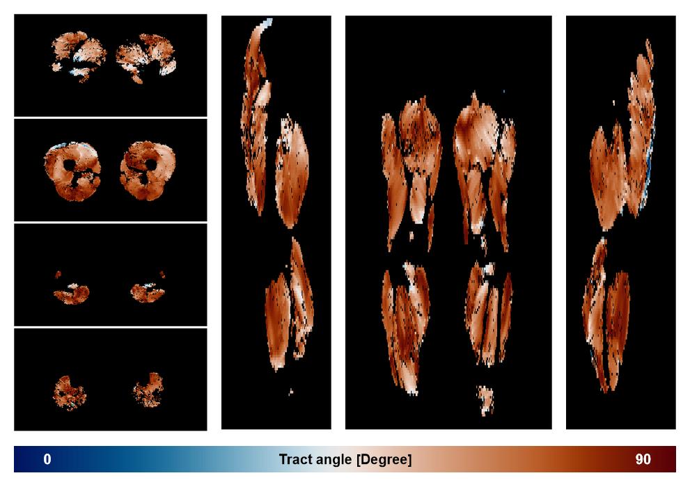 Muscle fiber tract angle map based on whole leg DTI based fiber tractography.