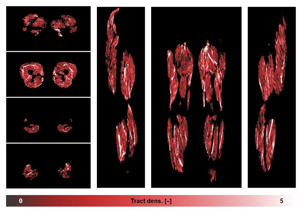 Muscle fiber tract density map based on whole leg DTI based fiber tractography.