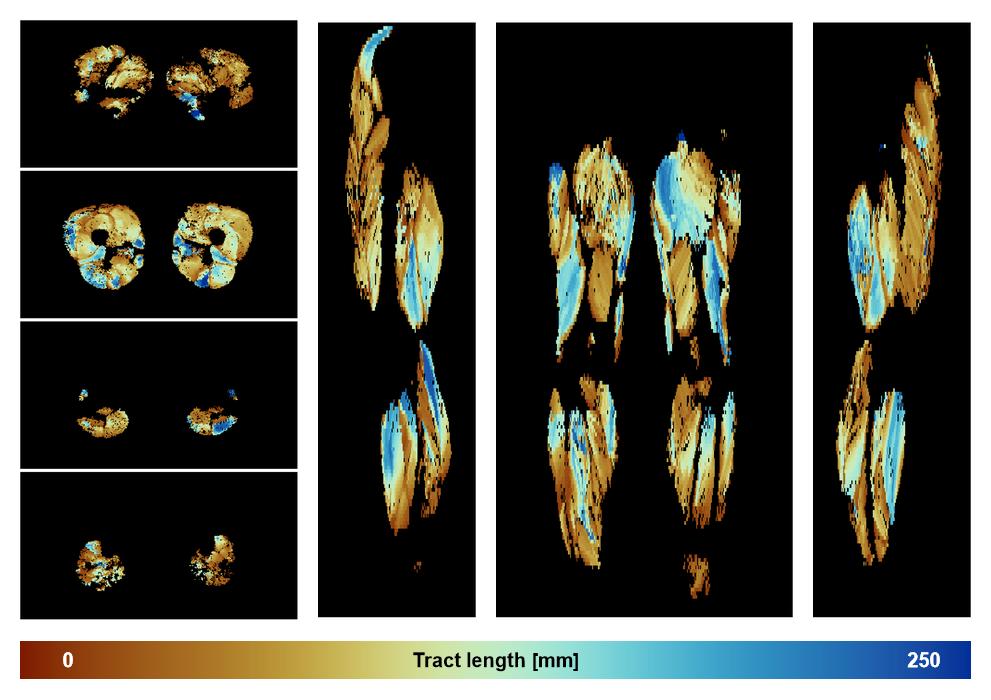 Muscle fiber tract length map based on whole leg DTI based fiber tractography.