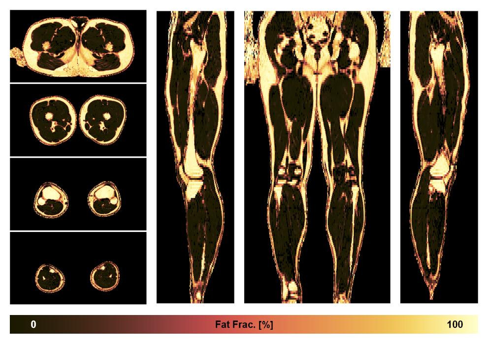 The fat fraction of the lower extremity obtained from the dixon reconstruction for muscle water fat quantification.