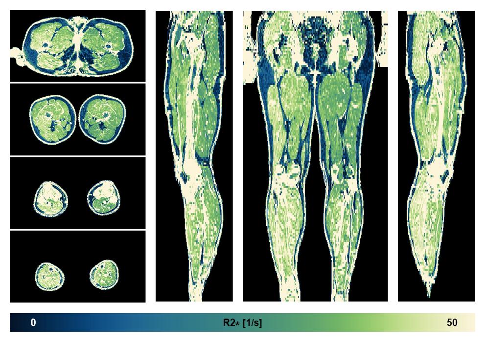 The R2 star relaxation time of the lower extremity obtained from the dixon reconstruction for muscle water fat quantification.