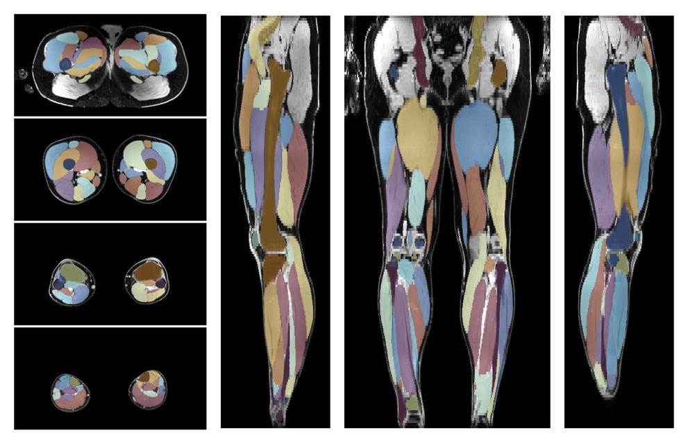 Overlay of automated muscle segmentation labels on dixon water image.