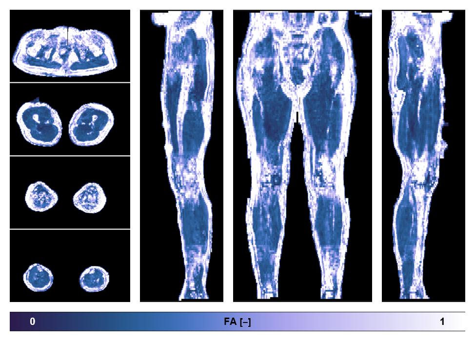 IVIM corrected whole leg muscle fractional anisotropy obtained from diffusion tensor imaging.