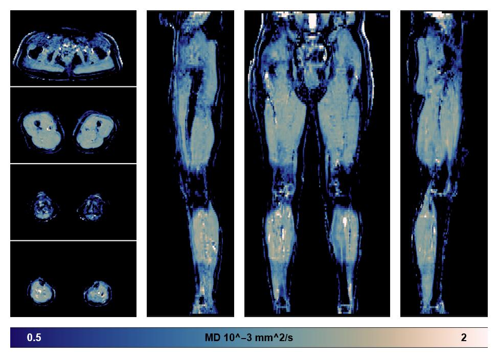 IVIM corrected whole leg muscle mean diffusivity obtained from diffusion tensor imaging.