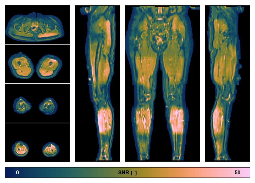 SNR distribution of the unweighted diffusion data.