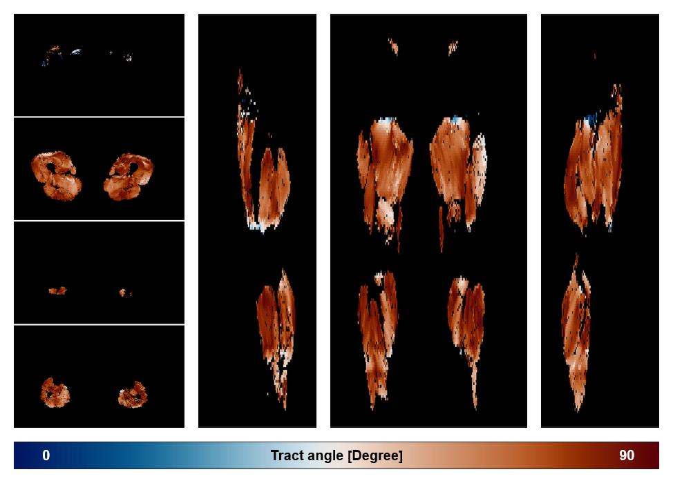 Muscle fiber tract angle map based on whole leg DTI based fiber tractography.