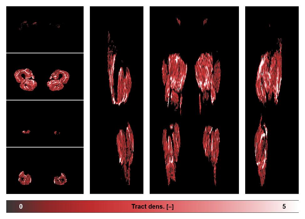 Muscle fiber tract density map based on whole leg DTI based fiber tractography.