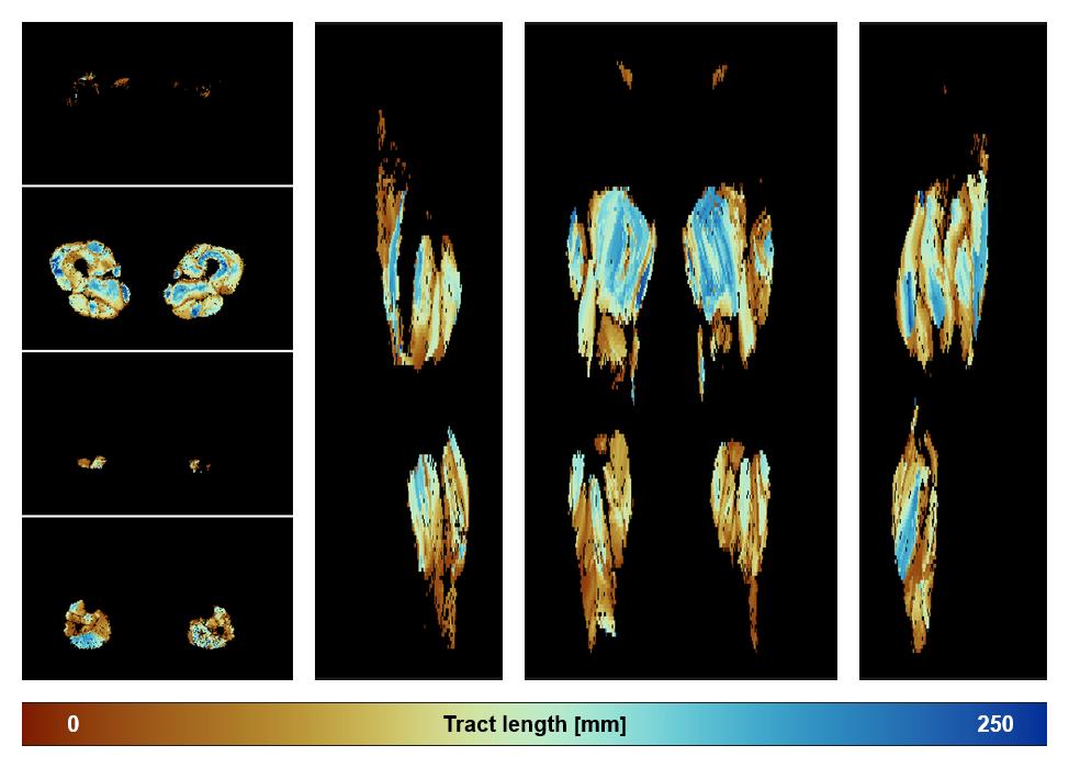 Muscle fiber tract length map based on whole leg DTI based fiber tractography.
