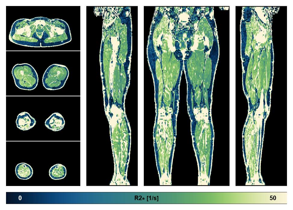 The R2 star relaxation time of the lower extremity obtained from the dixon reconstruction for muscle water fat quantification.