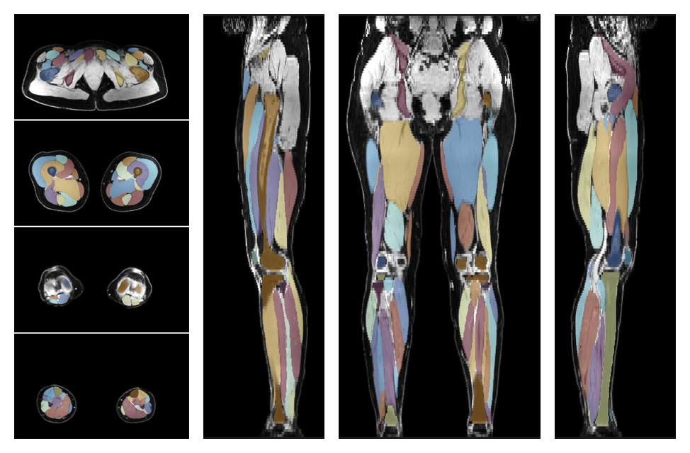 Overlay of automated muscle segmentation labels on dixon water image.