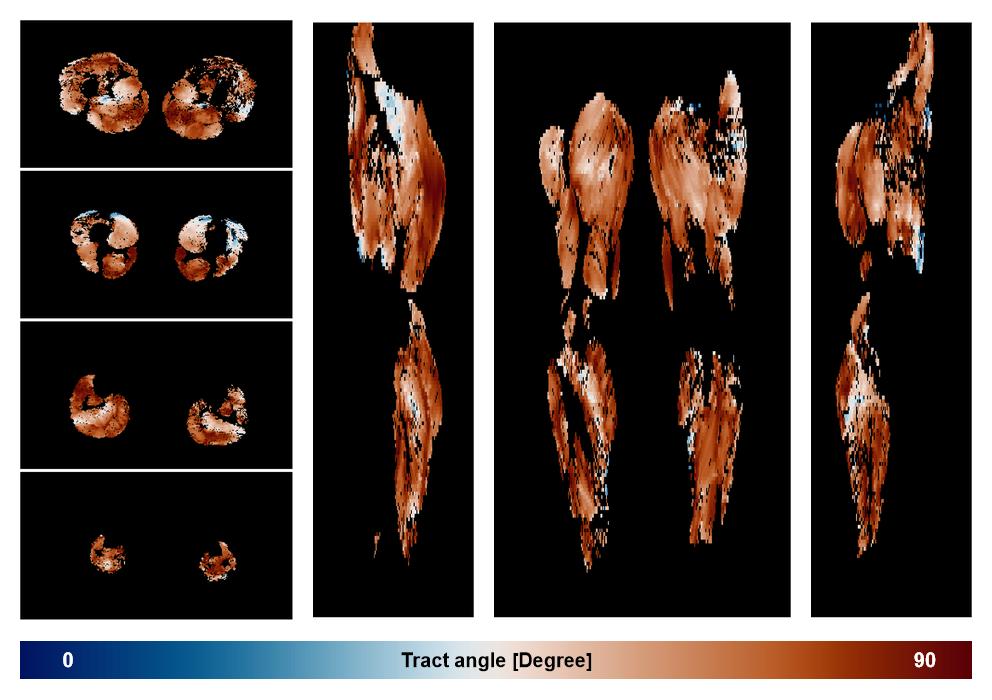 Muscle fiber tract angle map based on whole leg DTI based fiber tractography.
