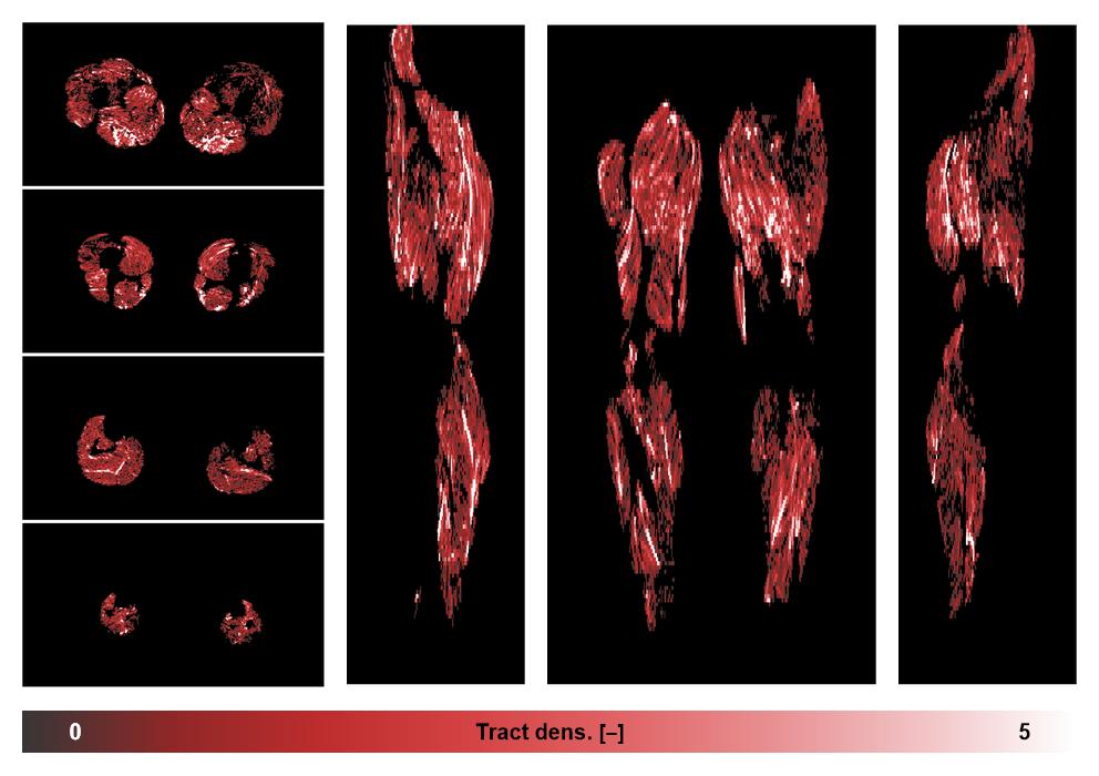 Muscle fiber tract density map based on whole leg DTI based fiber tractography.