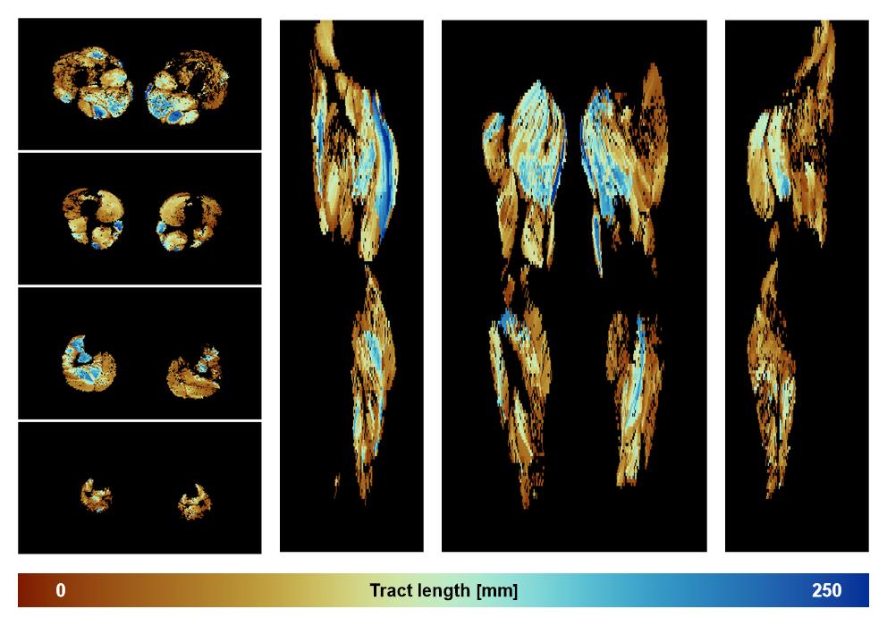 Muscle fiber tract length map based on whole leg DTI based fiber tractography.