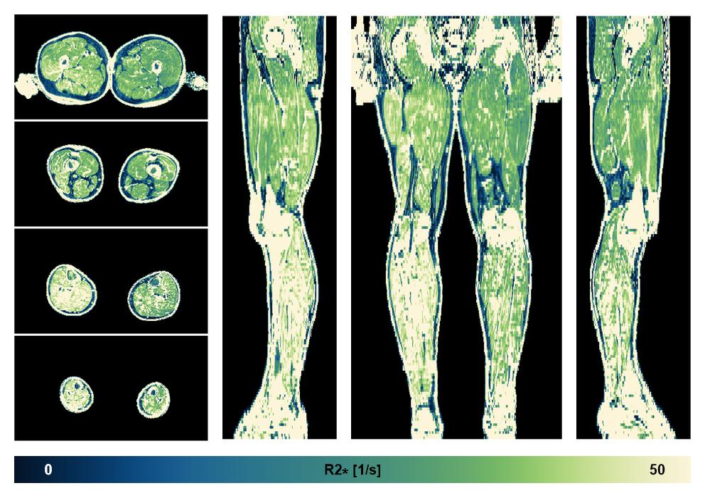 The R2 star relaxation time of the lower extremity obtained from the dixon reconstruction for muscle water fat quantification.
