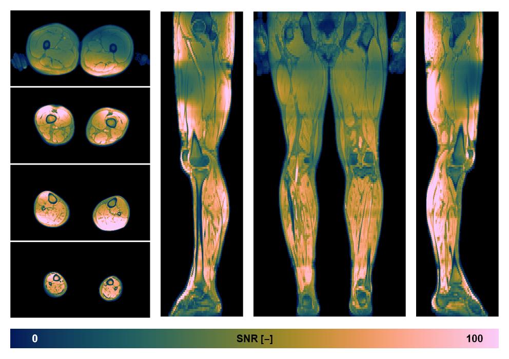 The SNR distribution of the dixon data.
