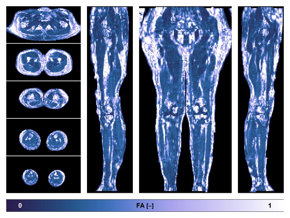 IVIM corrected whole leg muscle fractional anisotropy obtained from diffusion tensor imaging.