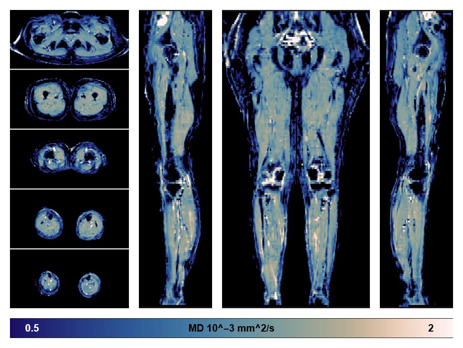 IVIM corrected whole leg muscle mean diffusivity obtained from diffusion tensor imaging.