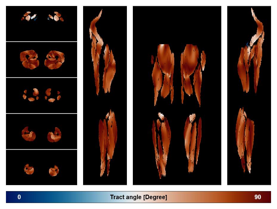 Muscle fiber tract angle map based on whole leg DTI based fiber tractography.