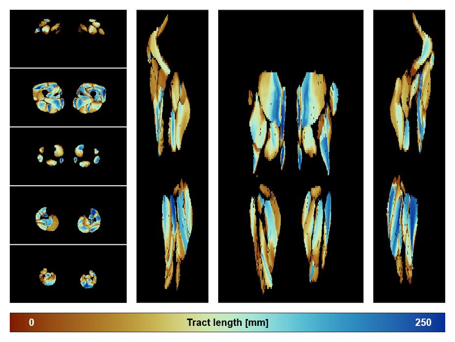 Muscle fiber tract length map based on whole leg DTI based fiber tractography.