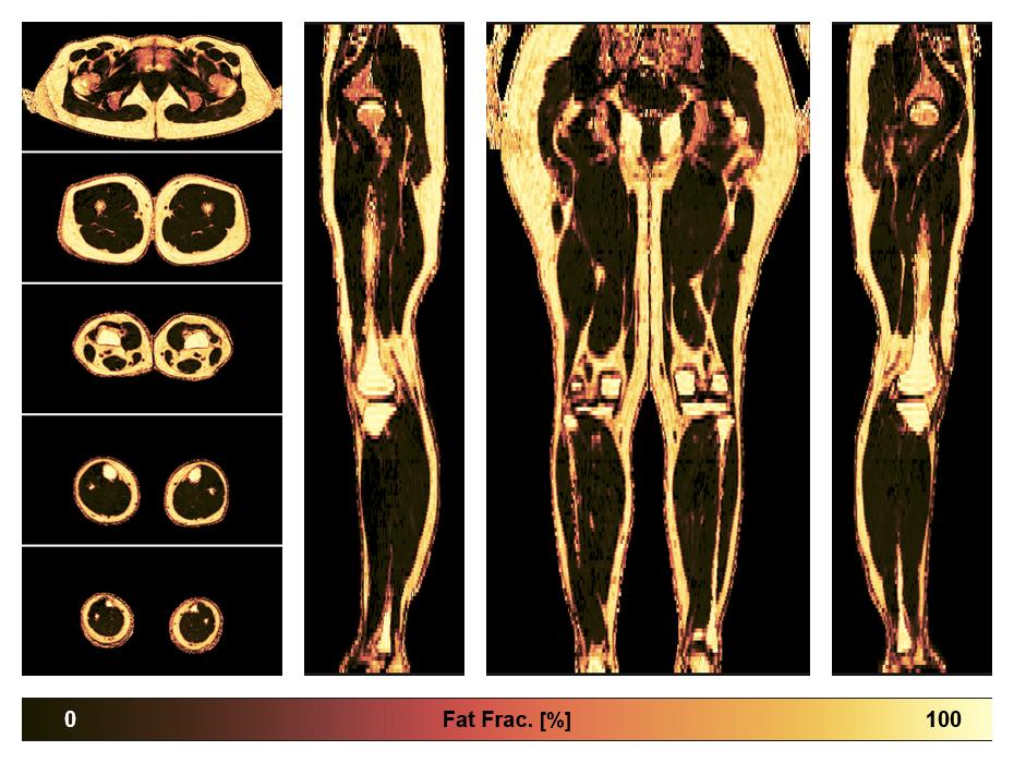 The fat fraction of the lower extremity obtained from the dixon reconstruction for muscle water fat quantification.