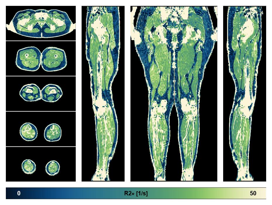 The R2 star relaxation time of the lower extremity obtained from the dixon reconstruction for muscle water fat quantification.