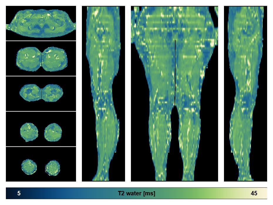 The water only T2 relaxation time of the lower extremity obtained from multi echo spin echo t2 mapping with EPG based reconstruction.