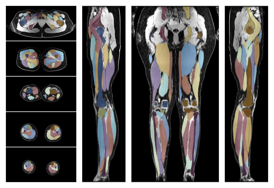 Overlay of automated muscle segmentation labels on dixon water image.