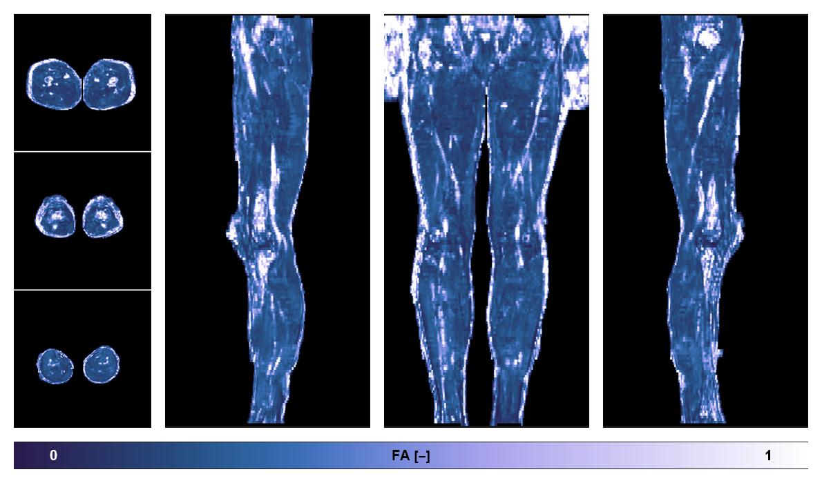 IVIM corrected whole leg muscle fractional anisotropy obtained from diffusion tensor imaging.