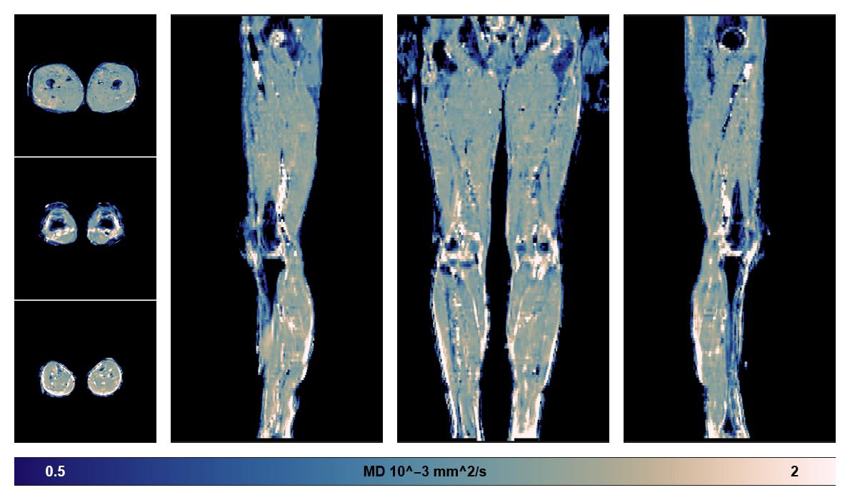 IVIM corrected whole leg muscle mean diffusivity obtained from diffusion tensor imaging.