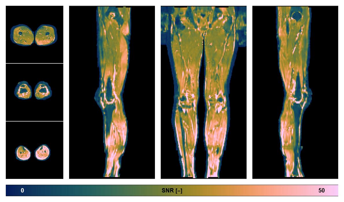 SNR distribution of the unweighted diffusion data.
