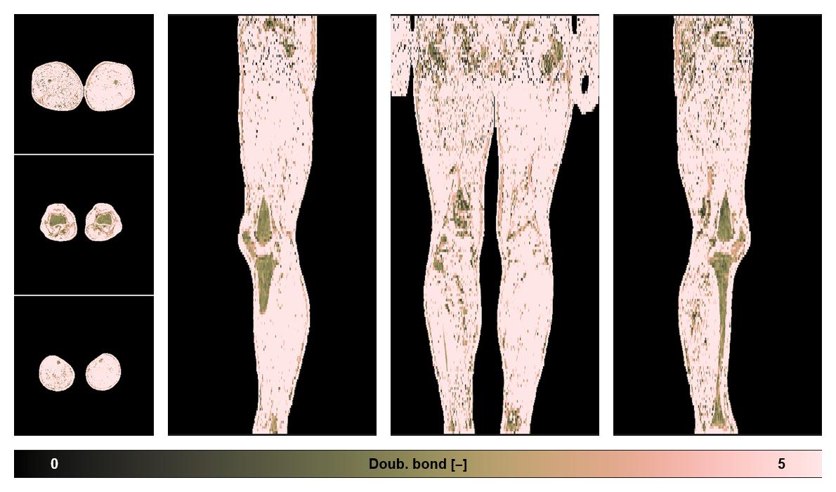 Number of double bonds in subcutanious fat.