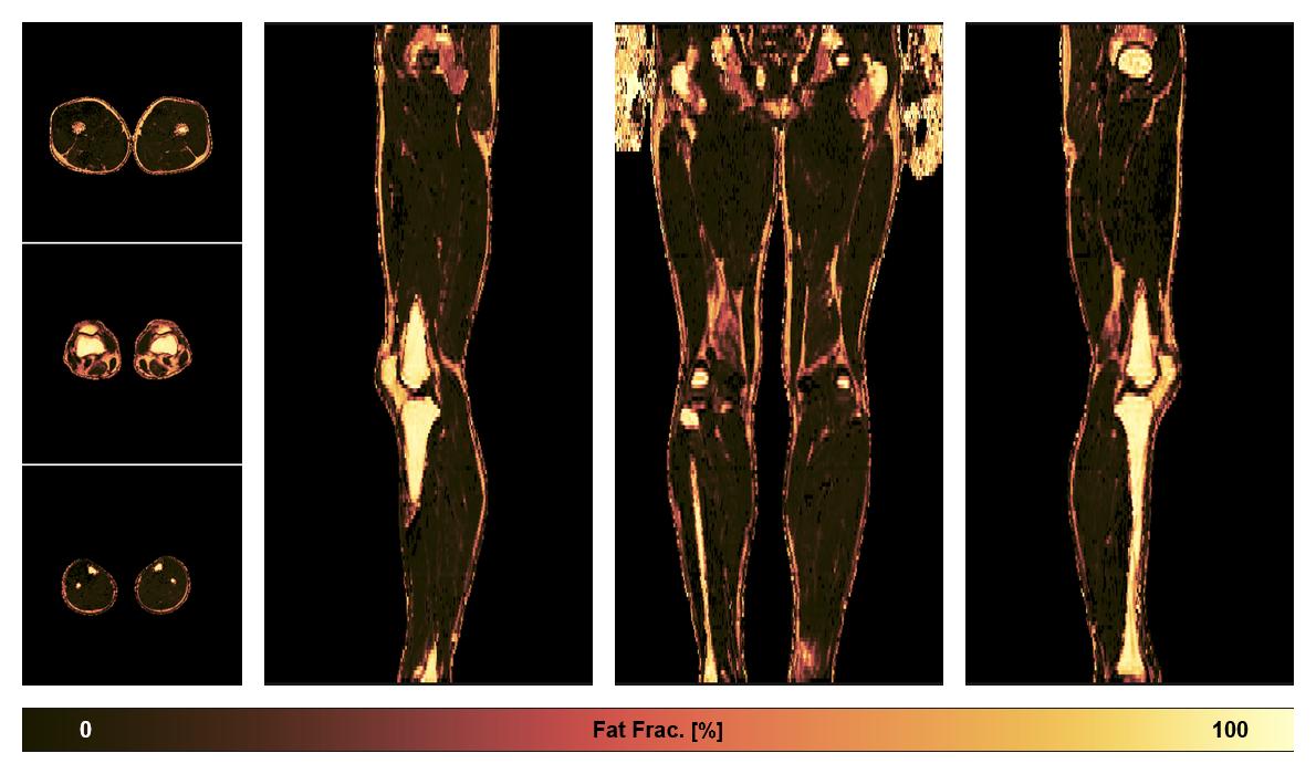 The fat fraction of the lower extremity obtained from the dixon reconstruction for muscle water fat quantification.