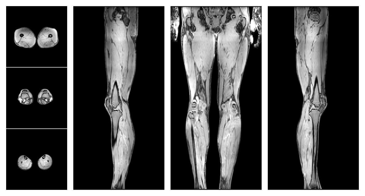 The out-phase image of the dixon reconstruction for water fat quantification.