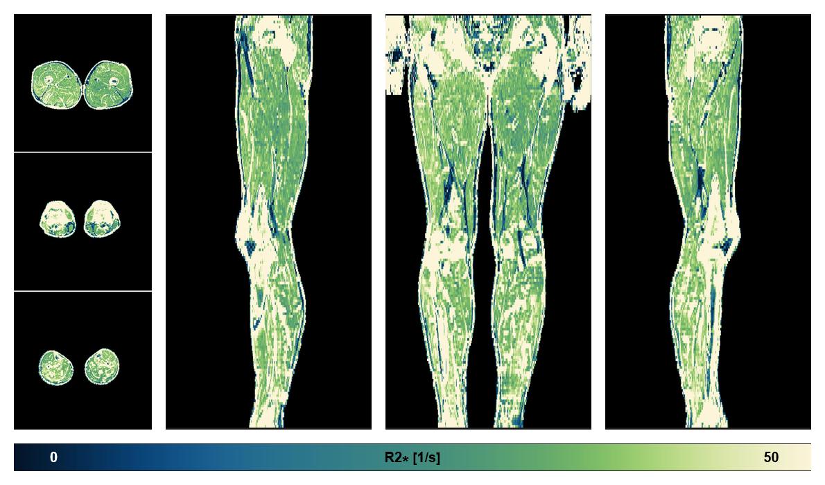 The R2 star relaxation time of the lower extremity obtained from the dixon reconstruction for muscle water fat quantification.
