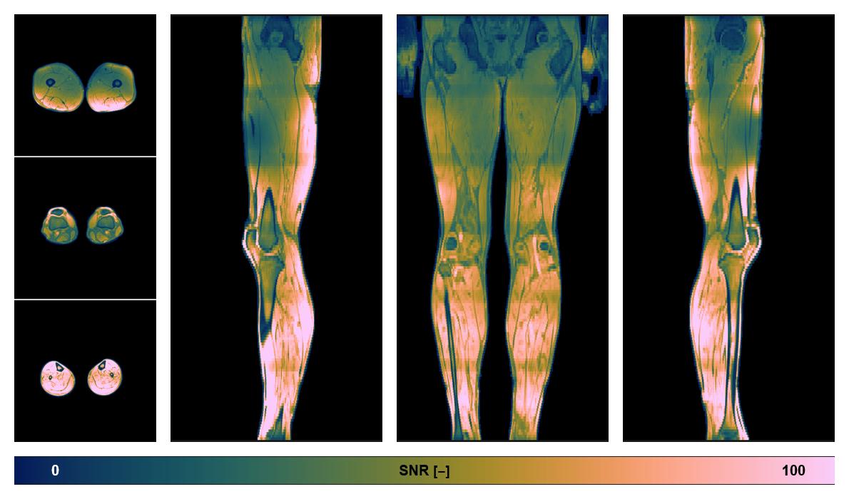 The SNR distribution of the dixon data.