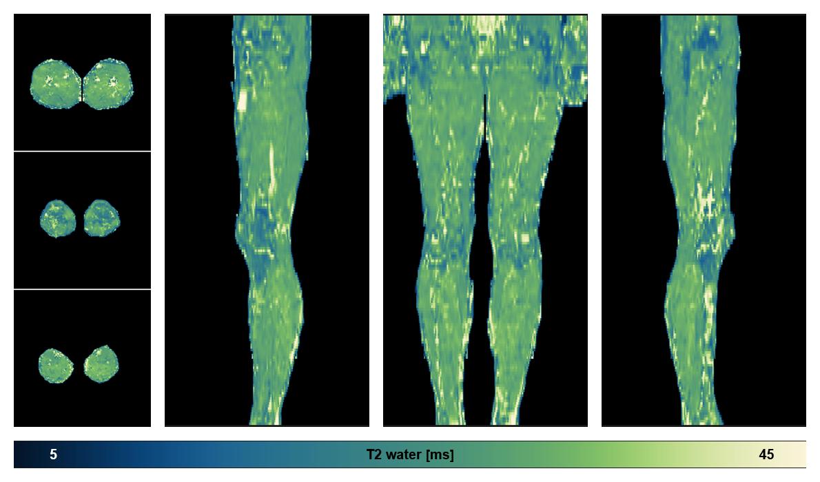 The water only T2 relaxation time of the lower extremity obtained from multi echo spin echo t2 mapping with EPG based reconstruction.