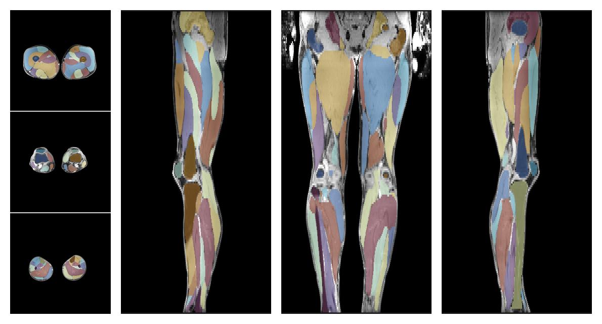 Overlay of automated muscle segmentation labels on dixon water image.
